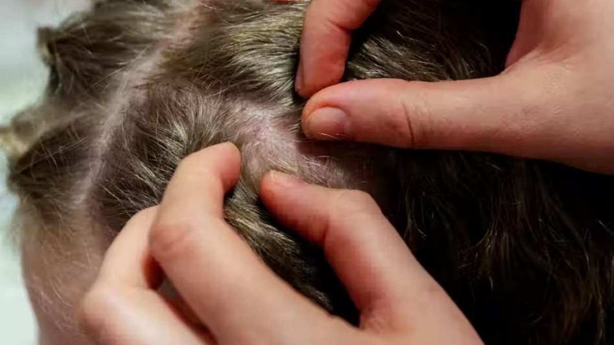 Recomiendan revisar higiene personal de los alumnos para evitar brote de piojos